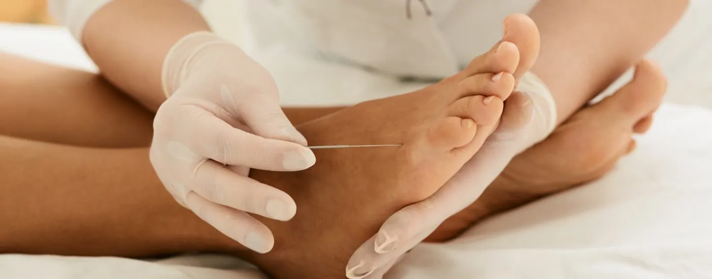 Chiropractor doing acupuncture therapy for female feet with needles. Acupuncture treatment for chronic foot pain